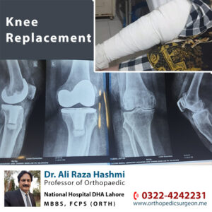 Best Knee Replacement Surgeon in Lahore